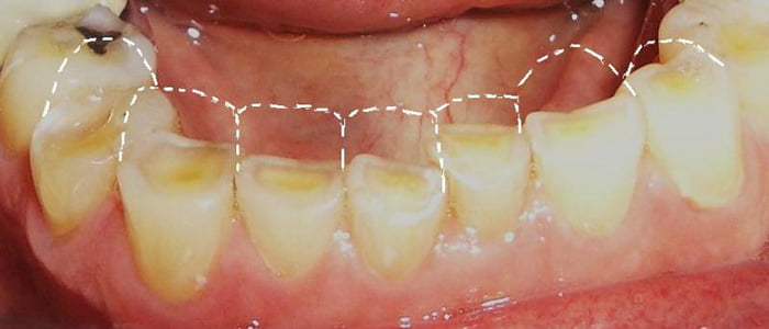 Bruxism (teeth grinding)