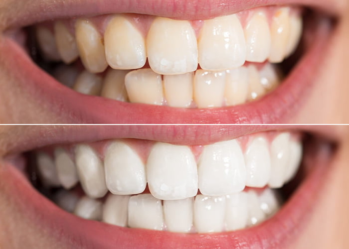 Using a whitening toothpaste