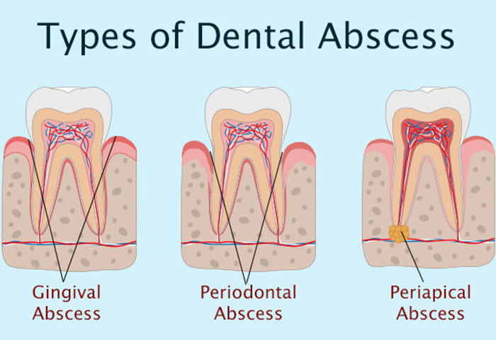 Different types of dental abscess