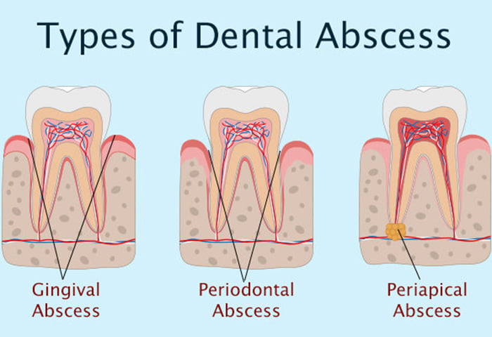 all-about-dental-abscesses-dentist-for-life