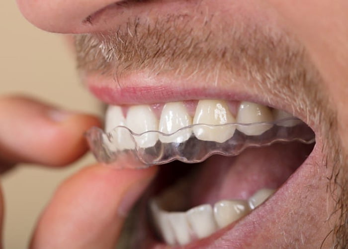 What Is Bruxism?
