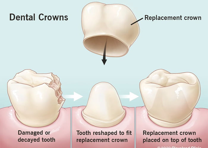 What is a dental crown?