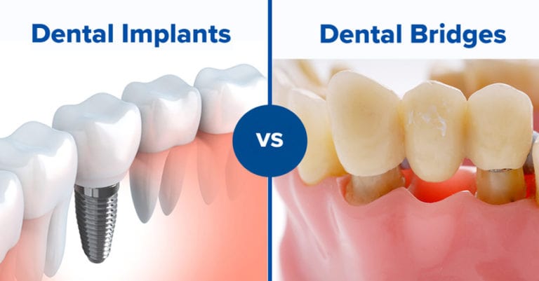 Dental Implant vs. Dental Bridge: Which is Better?