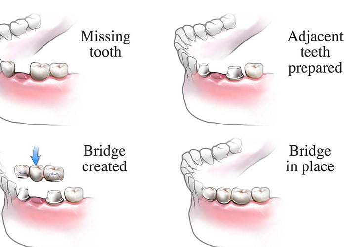 Dental Bridge