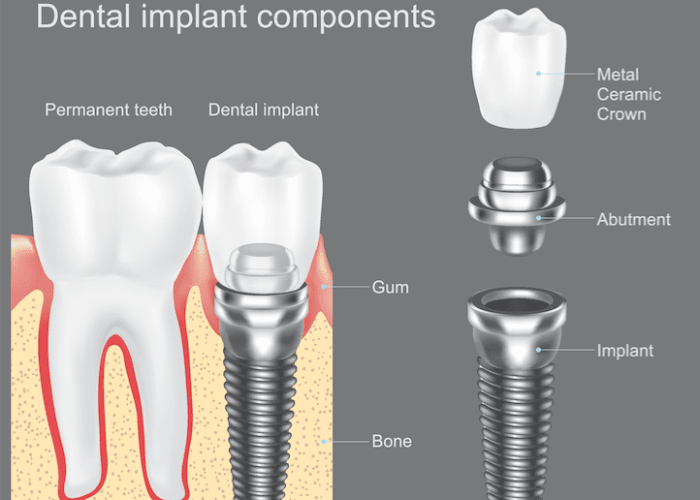 Dental Implant