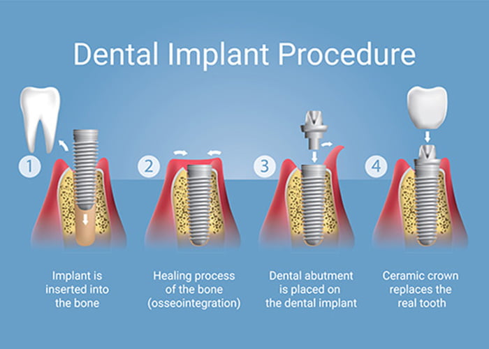  Advantages to choosing a dental implant over a dental bridge