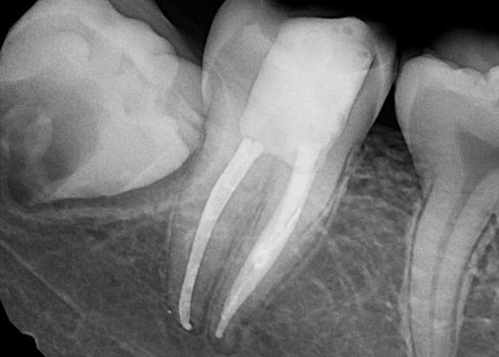 How long do root canals take?
