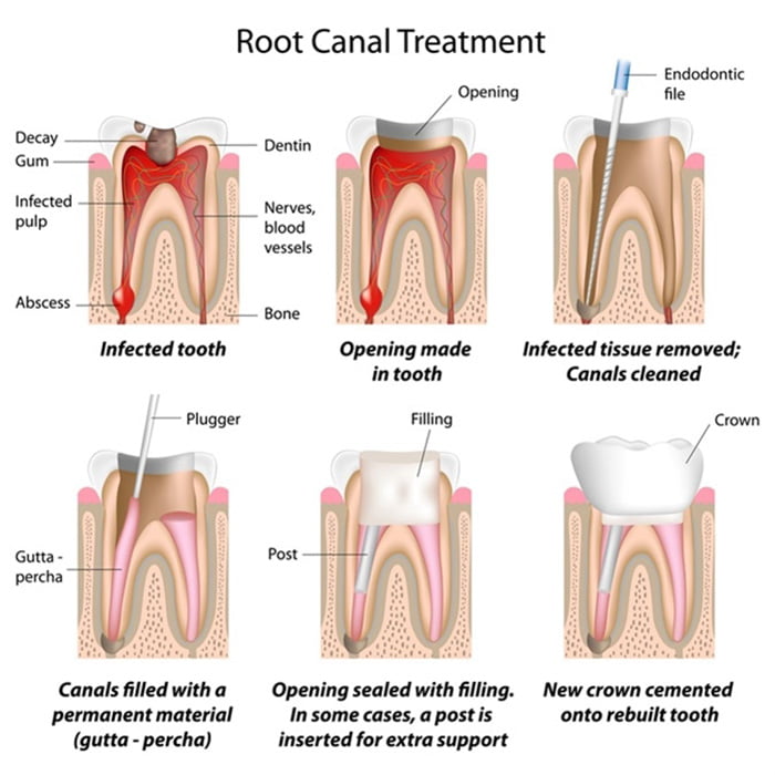 How are root canals performed?