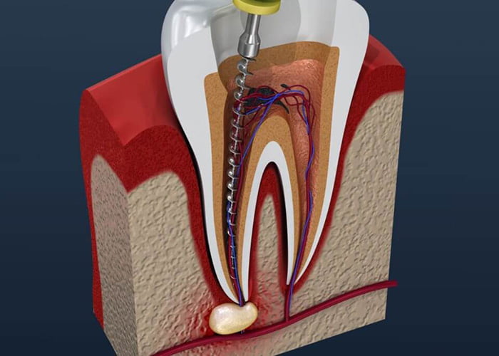 What is a root canal?