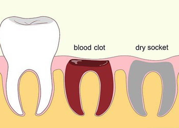 dry sockets in teeth