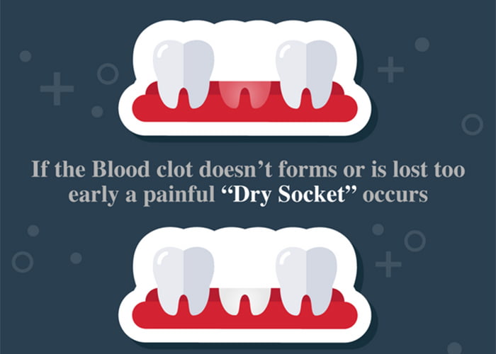 Causes: What causes a dry socket?