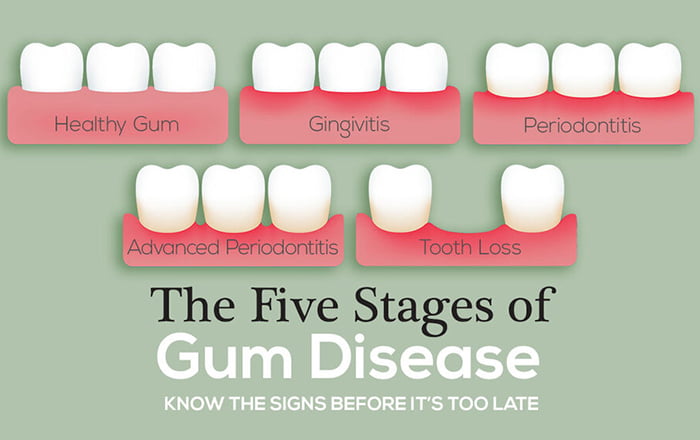 What is gum disease and what are the different types?