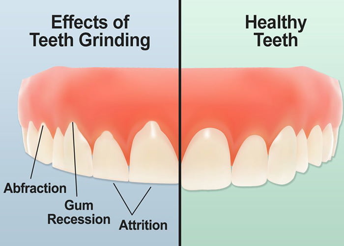 What is Teeth Grinding? 