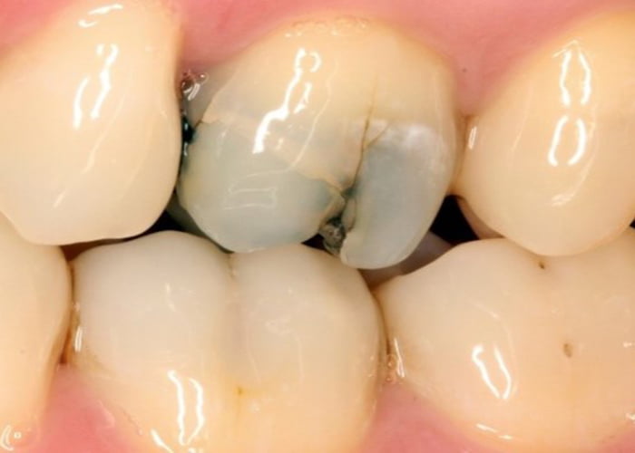 Treating a cracked tooth with a dental crown
