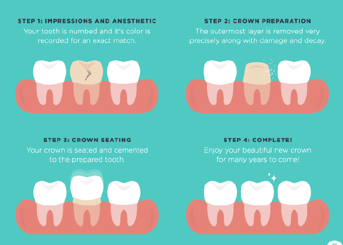 The dental crown process