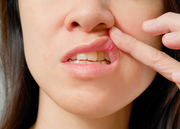 canker sore on cheek near wisdom tooth