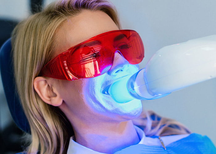 Professional Teeth Whitening: What to Expect