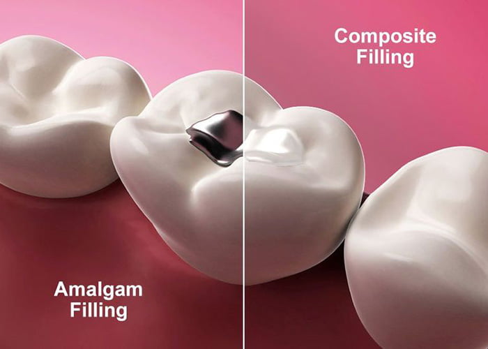 amalgam fillings vs composite