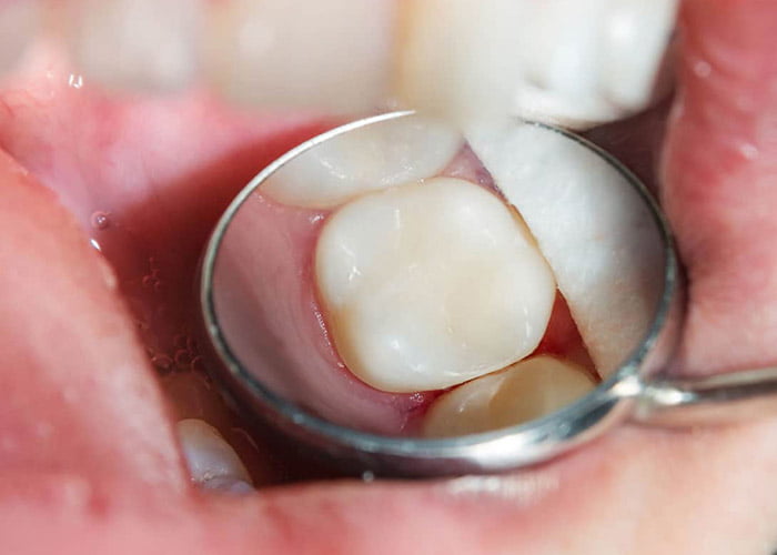 What are White Composite Fillings?