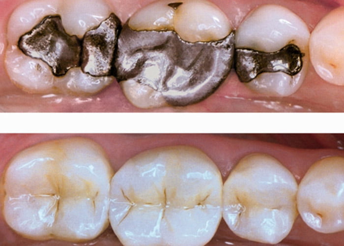 When do You Need to Replace Your Silver Fillings with White Fillings?