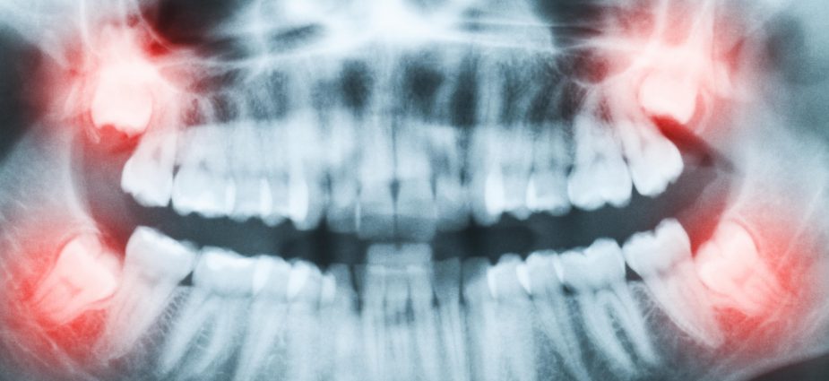 The age at which wisdom teeth need to be extracted 