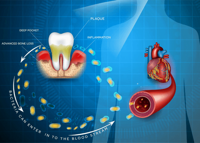 Heart Health and Gum Disease
