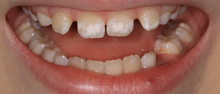 Why Do I Have White Spots on My Teeth?