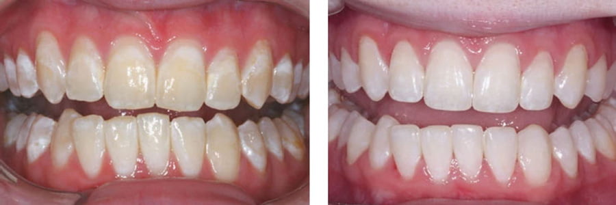 Treatments for White Spots on Teeth