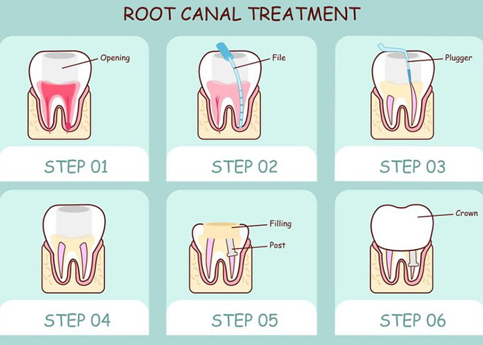 Crown after root canal