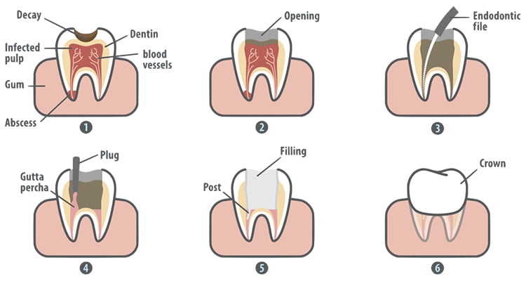 Will I Need a Dental Crown after Root Canal Treatment?