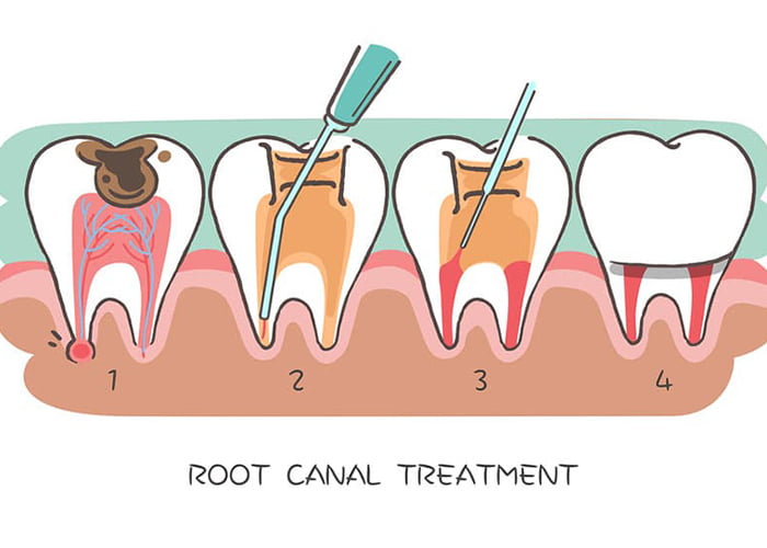 Will you need a dental crown after undergoing a root canal procedure?