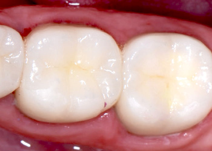 Composite Dental Filling Costs