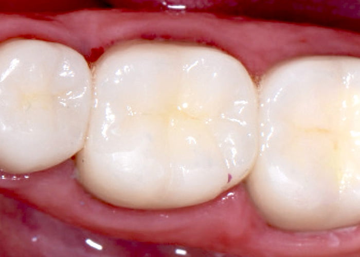 What does a composite filling look like?