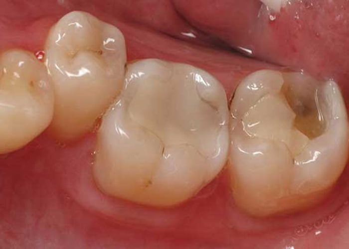 Composite fillings drawbacks