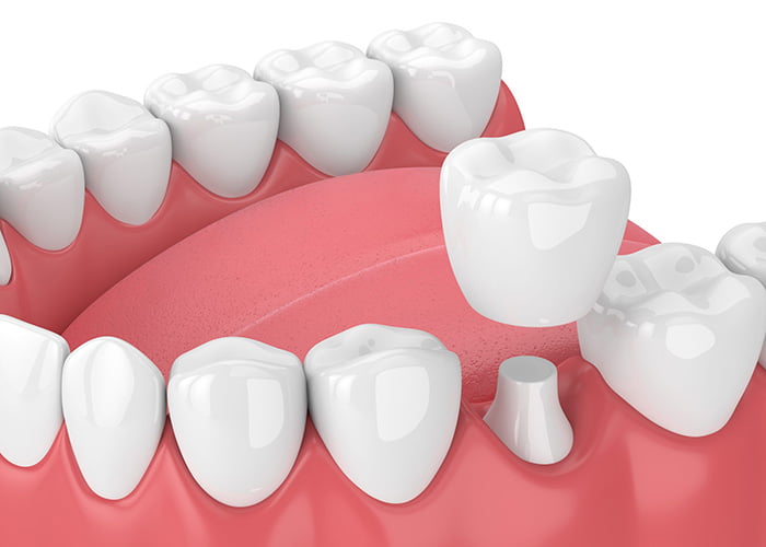 The Pros and Cons of a Dental crown