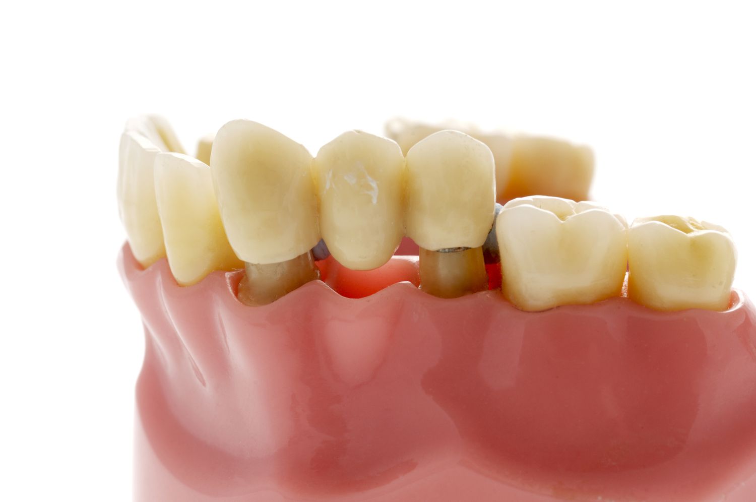 The Pros and Cons of a Dental Bridge
