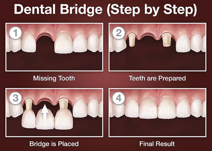 Pros of Dental Bridges