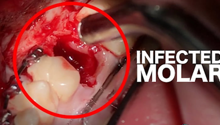 Pictures of infected tooth extraction