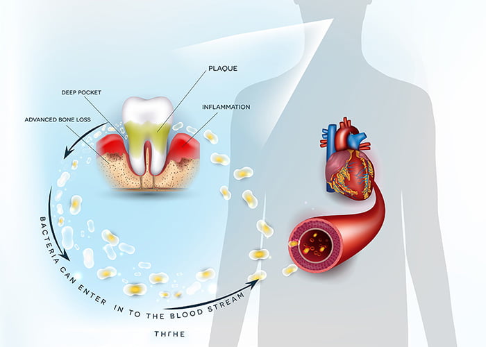 Complications with tooth extraction