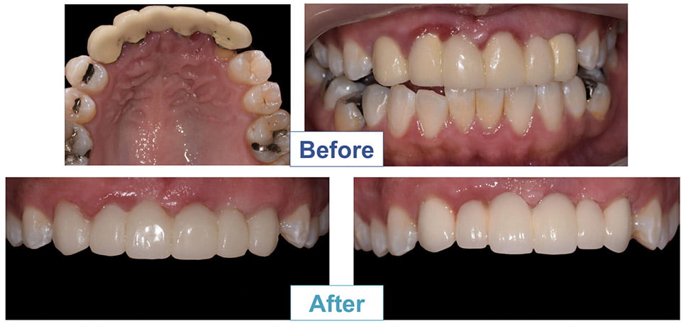 Process of Placing Cosmetic Fillings