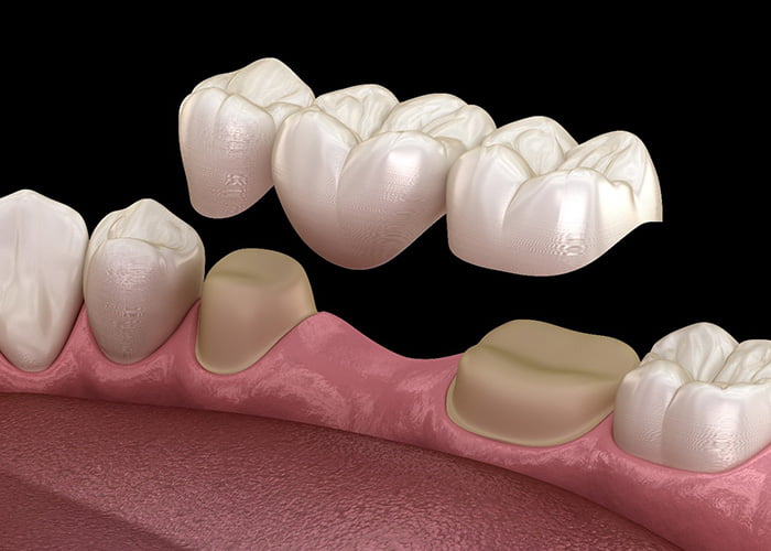 How Much Does a Dental Bridge Cost?