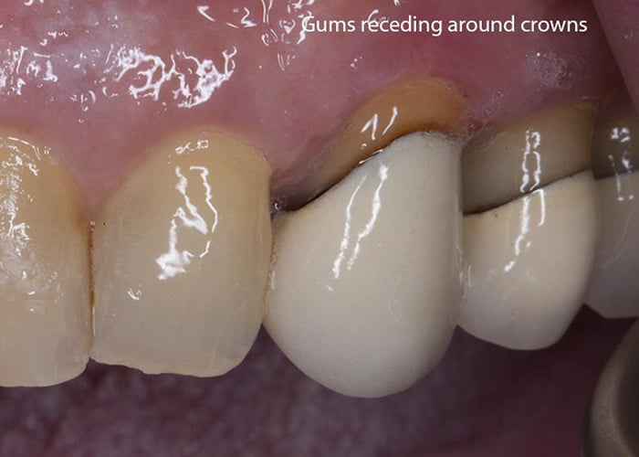 Common problems with dental bridges' collection of food debris
