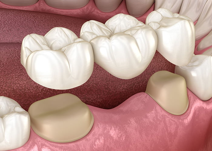 Traditional dental bridges