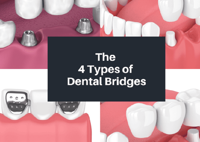 Dental bridge types