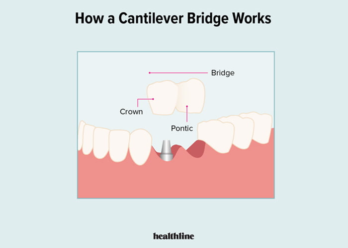  Cantilever bridges