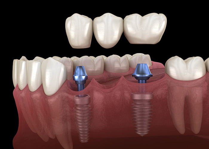 Implant-supported bridges