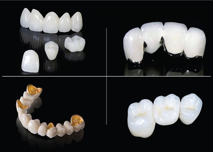 How Much Do Dental Crown Cost? Which type should I choose?