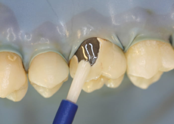 Dental crown repair