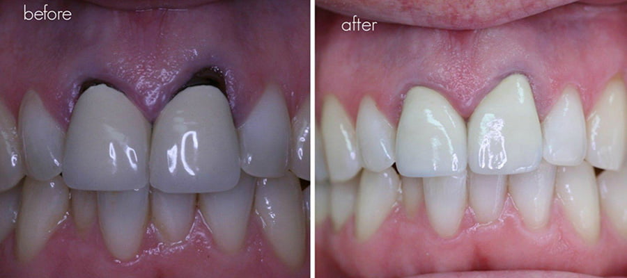 Cracked Crown Symptoms