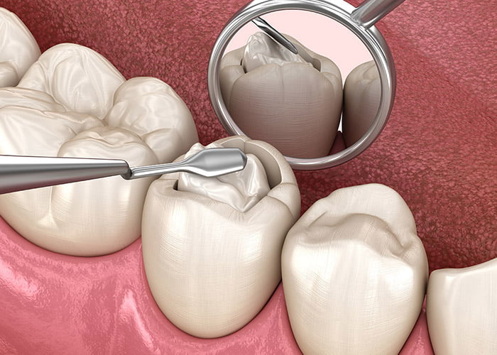 Cost Of Dental Fillings With No Insurance